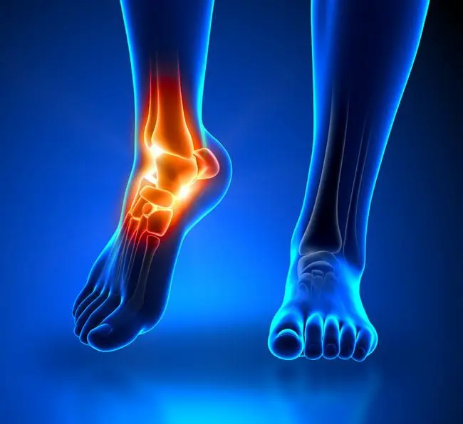 Protesi caviglia SmartHallux